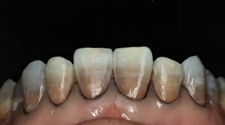 四环素牙有办法清理吗?