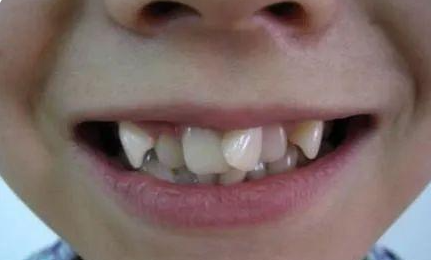 牙齿不齐，会遗传给孩子吗？